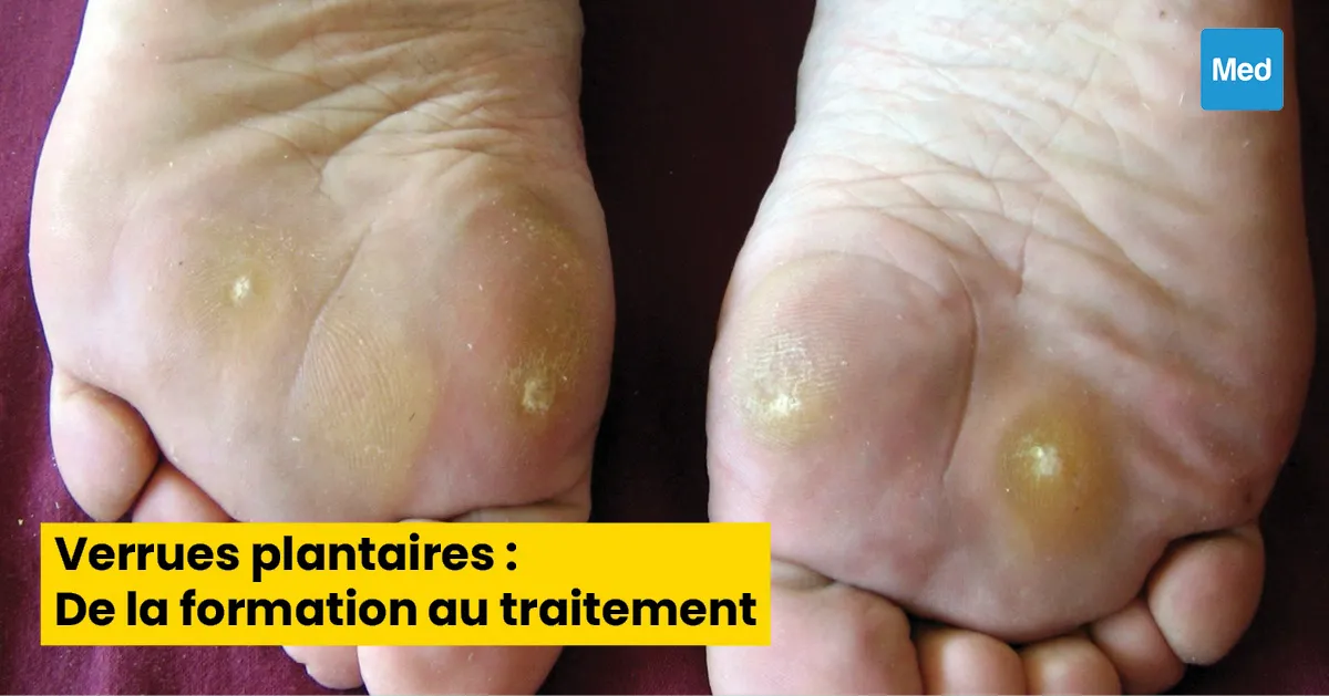 Verrues plantaires : De la formation au traitement